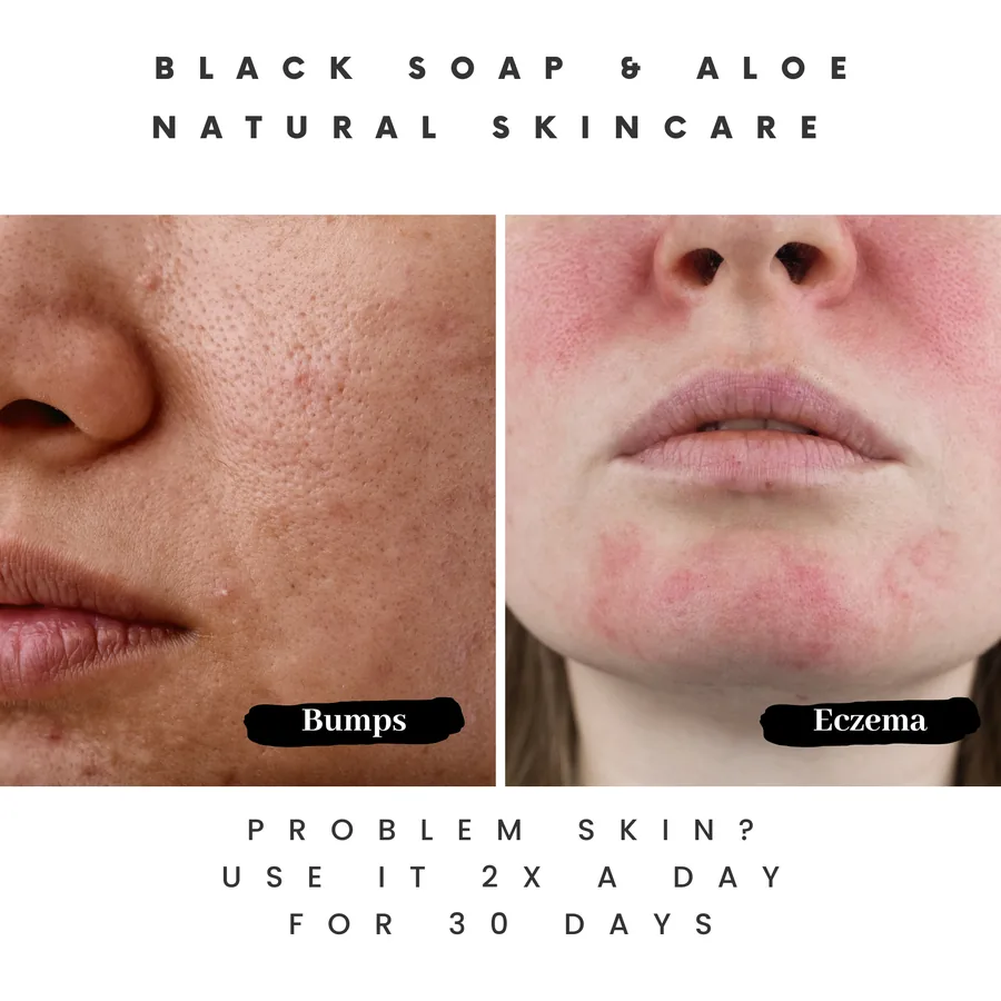 Helps with bumps and eczema