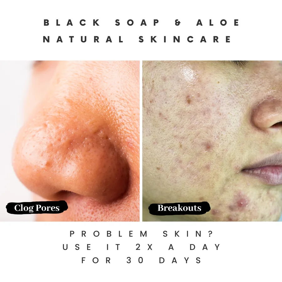 Helps with clogged pores and breakouts