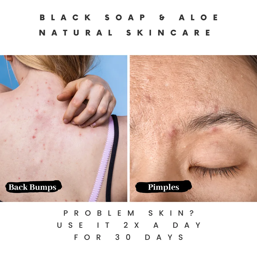 Helps with back bumps and pimples