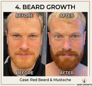 Before and after showing fuller-looking beard